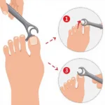 Using an ingrown toenail lifter to carefully lift the nail edge