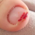 Infected Cuticle from Defective Nail Tool