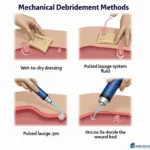 Mechanical Debridement Tools: Wet-to-Dry Dressings, Pulsed Lavage, and Ultrasonic Devices